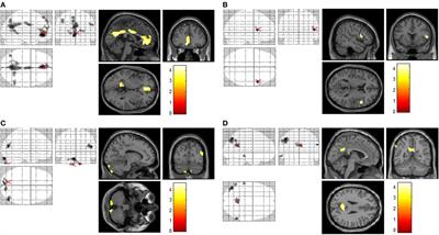 Cue-Induced Brain Activation in Chronic Ketamine-Dependent Subjects, Cigarette Smokers, and Healthy Controls: A Task Functional Magnetic Resonance Imaging Study